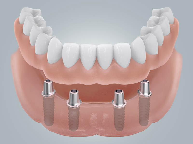 CAMLOG - Zahnloser Unterkiefer mit Doppelkronenversorgung
