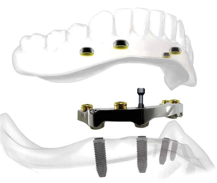 Herausnehmbare Implantatversorgung - Locator Prothese - Mit Genehmigung von Nobel Biocare