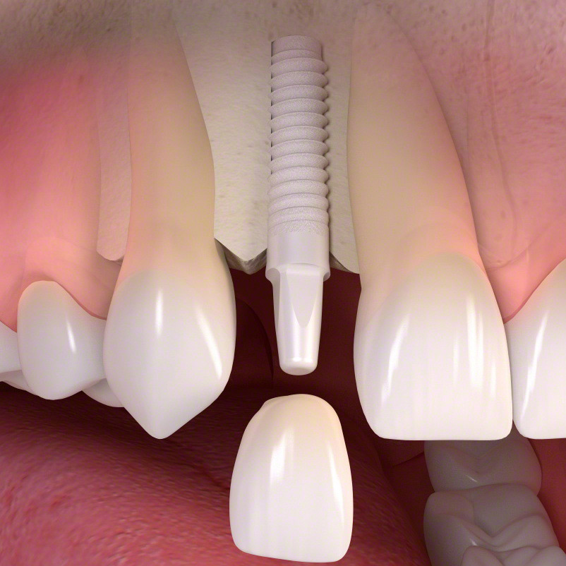 Implantat